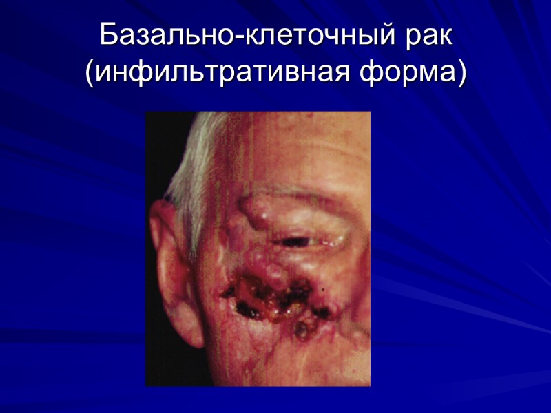 Базально-клеточный рак (инфильтративная форма)